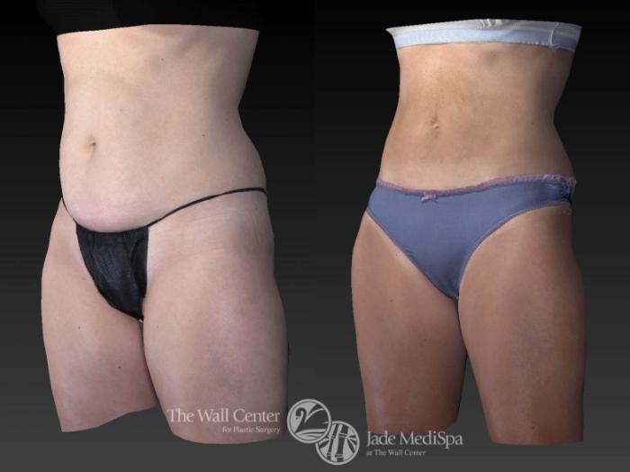 Before & After CoolSculpting Case 530 View #2 View in Shreveport, LA