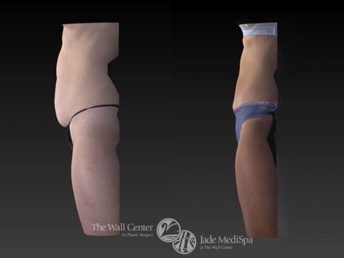 Before & After CoolSculpting Case 530 View #3 View in Shreveport, LA