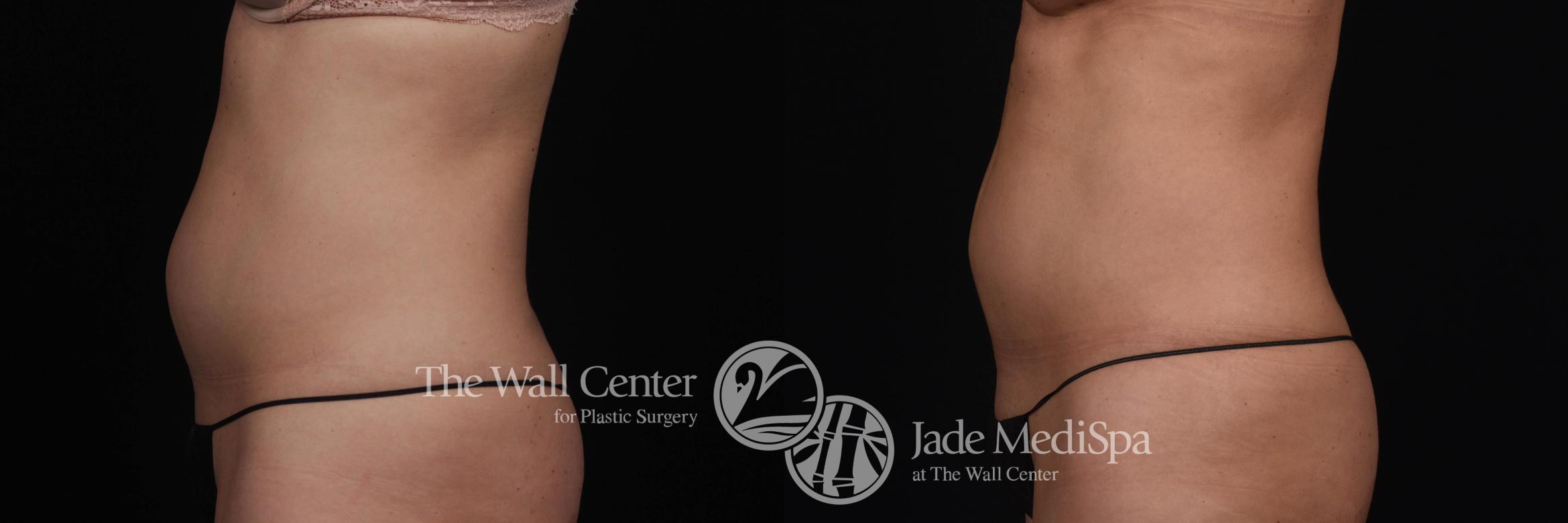 Before & After CoolSculpting Case 531 View #1 View in Shreveport, LA