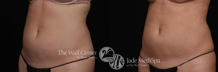 Before & After CoolSculpting Case 531 View #2 View in Shreveport, LA