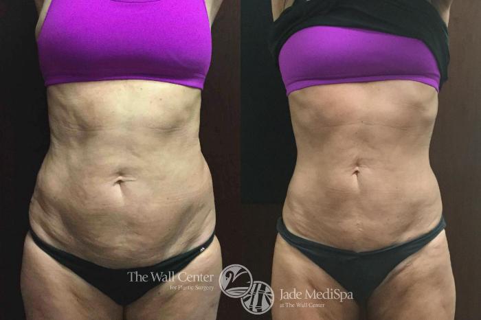 Before & After CoolSculpting Case 609 View #1 View in Shreveport, LA
