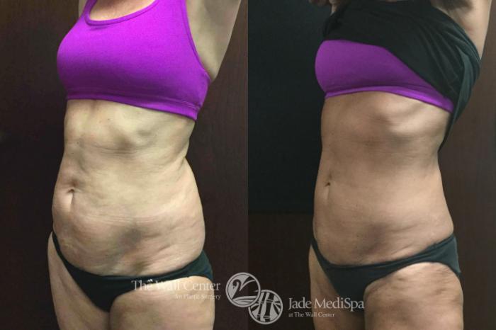Before & After CoolSculpting Case 609 View #2 View in Shreveport, LA