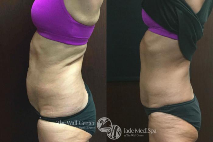 Before & After CoolSculpting Case 609 View #3 View in Shreveport, LA