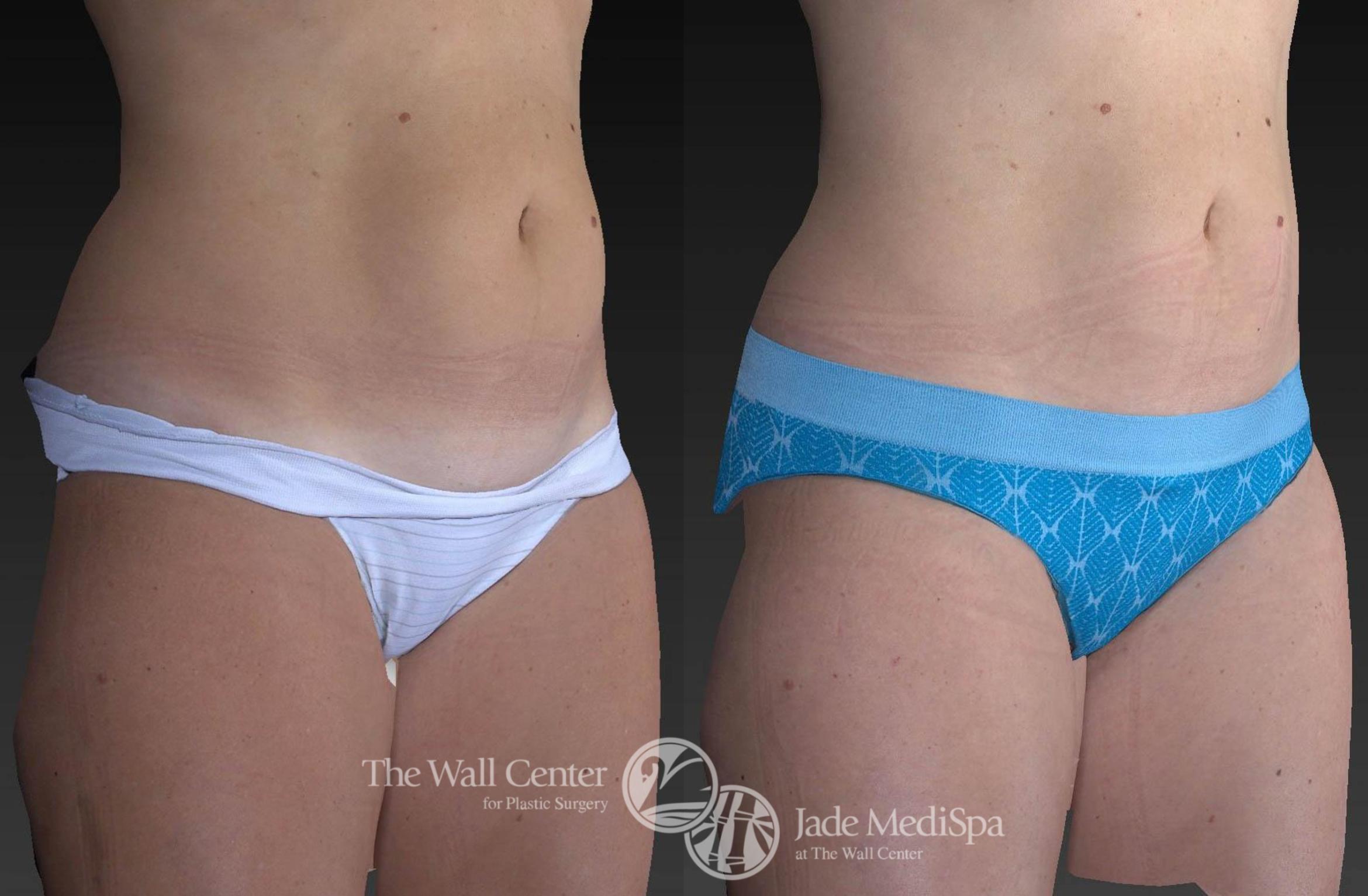 Before & After CoolSculpting Case 737 VIEW #1 View in Shreveport, LA