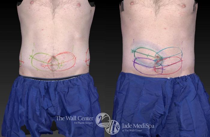 Before & After CoolSculpting Case 743 VIEW #1 View in Shreveport, LA