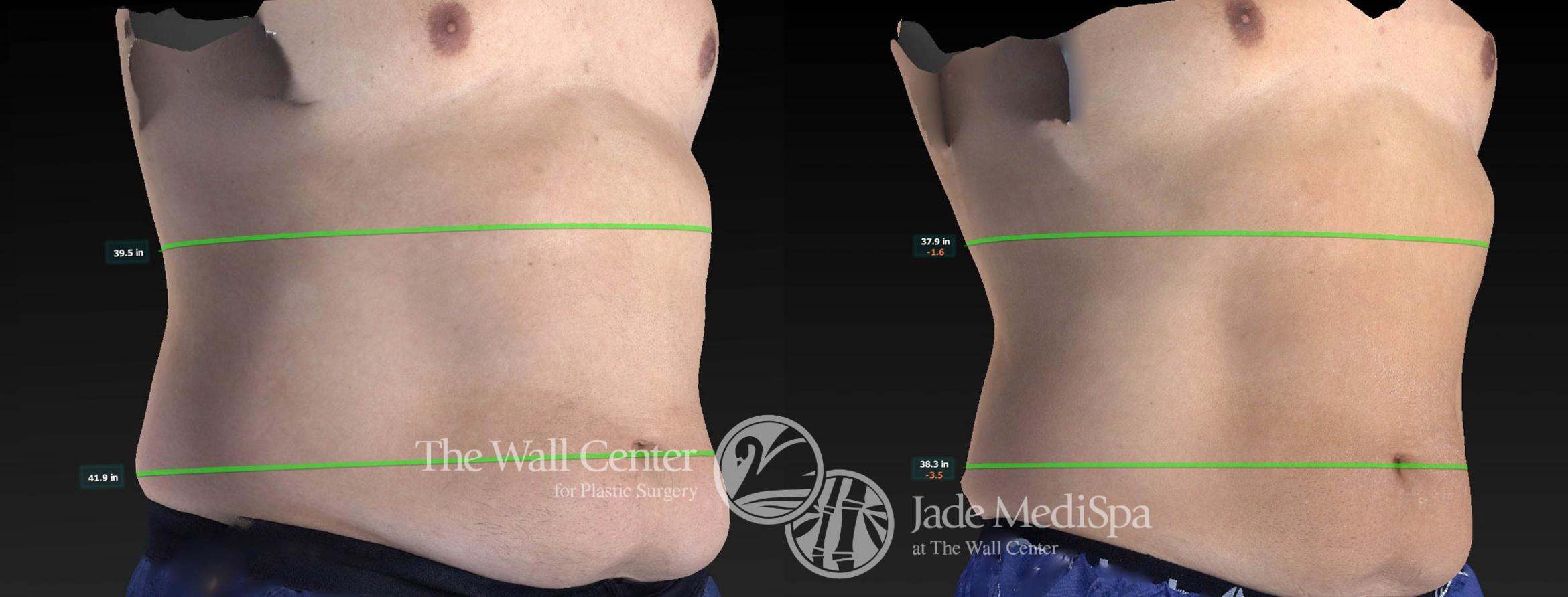 CoolSculpting Right Oblique Photo, Shreveport, Louisiana, Jade Medispa, The Wall Center, Case 821