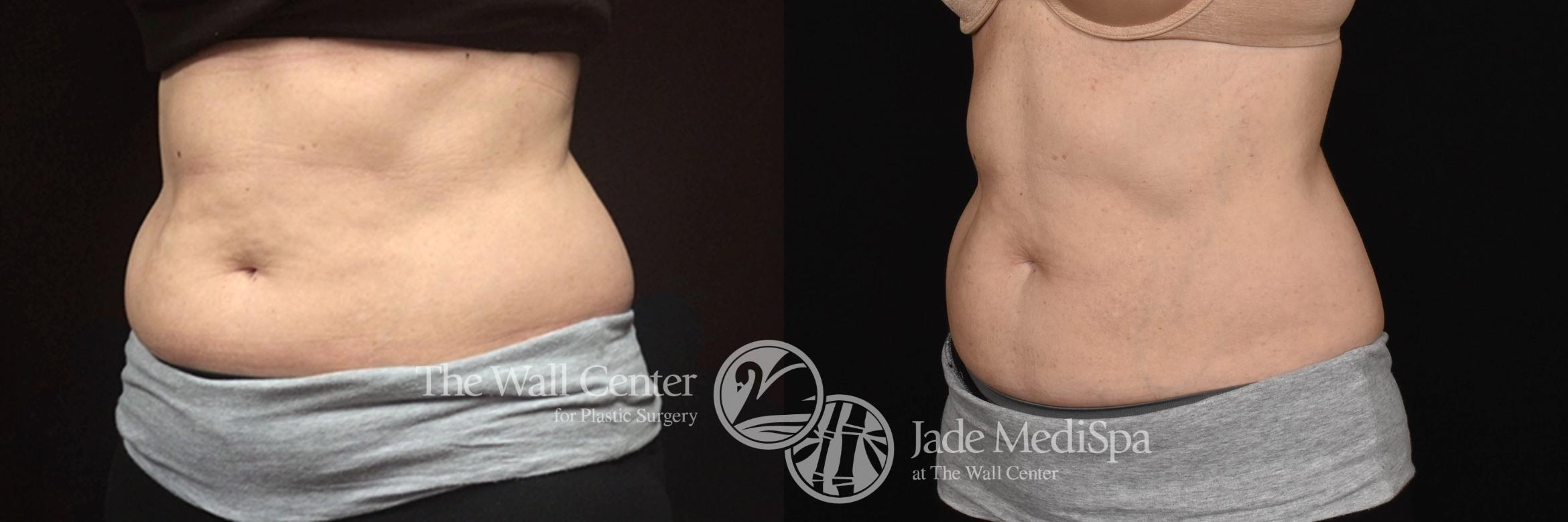 CoolSculpting Left Oblique Photo, Shreveport, Louisiana, Jade Medispa, The Wall Center, Case 836