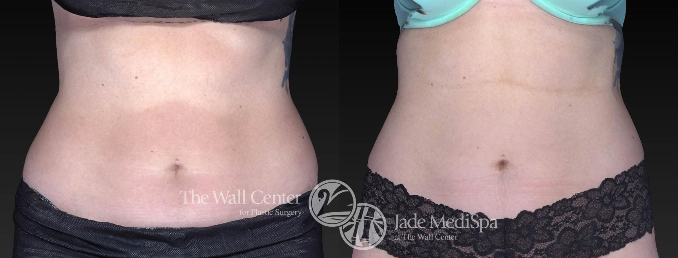 CoolSculpting Front Photo, Shreveport, Louisiana, Jade Medispa, The Wall Center, Case 920