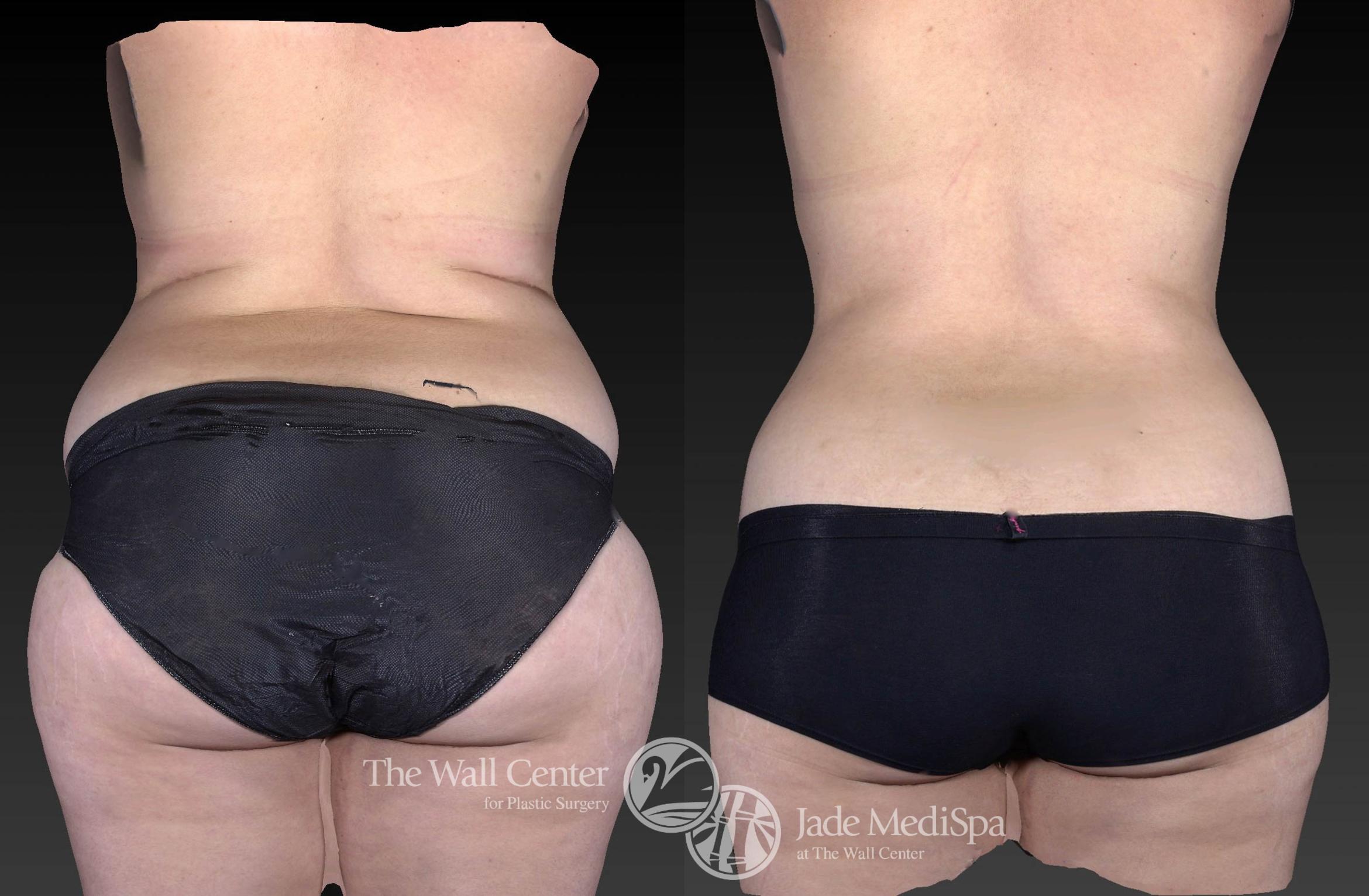 CoolSculpting Back Photo, Shreveport, Louisiana, Jade Medispa, The Wall Center, Case 922