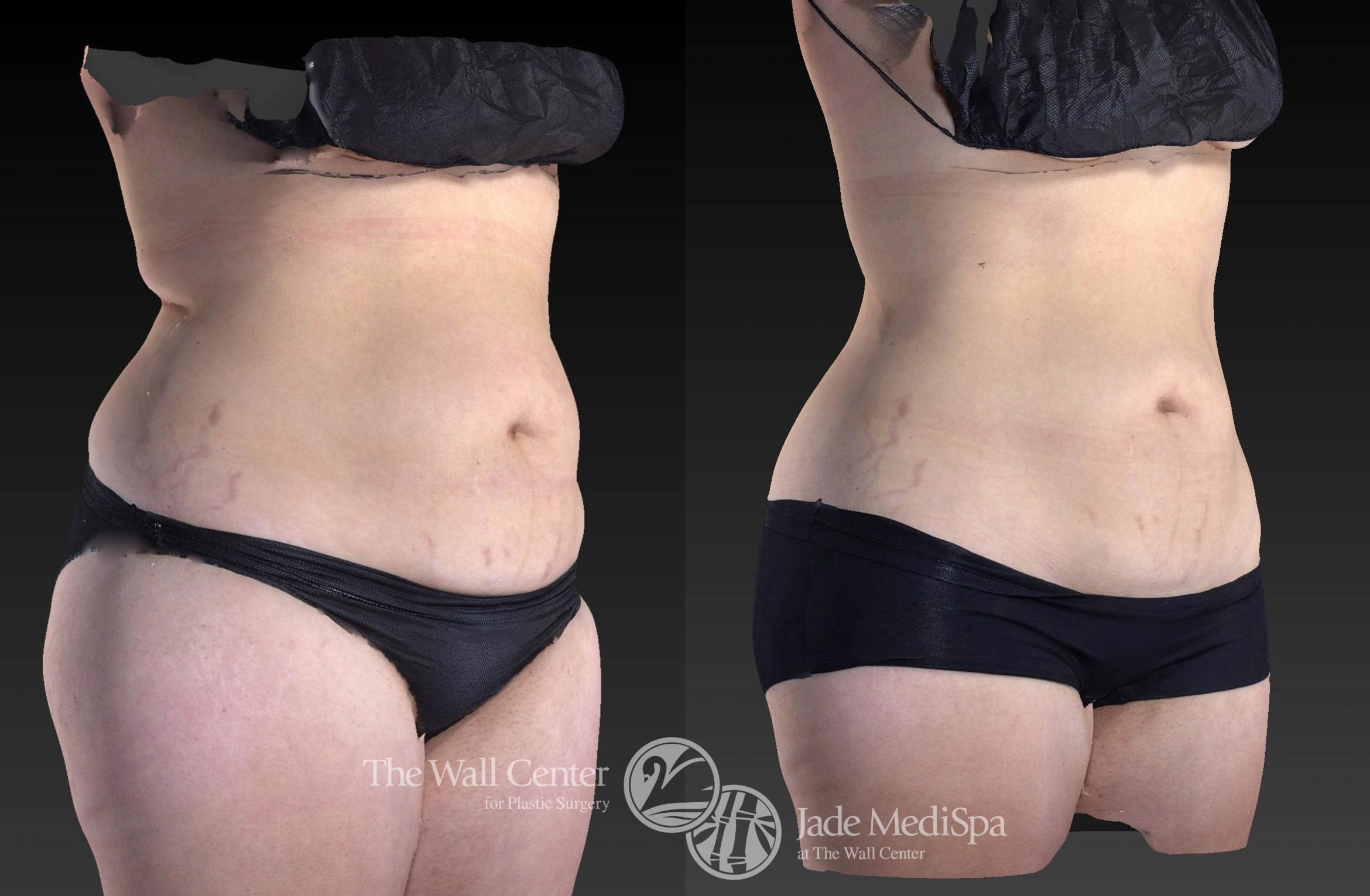 CoolSculpting Right Oblique Photo, Shreveport, Louisiana, Jade Medispa, The Wall Center, Case 922