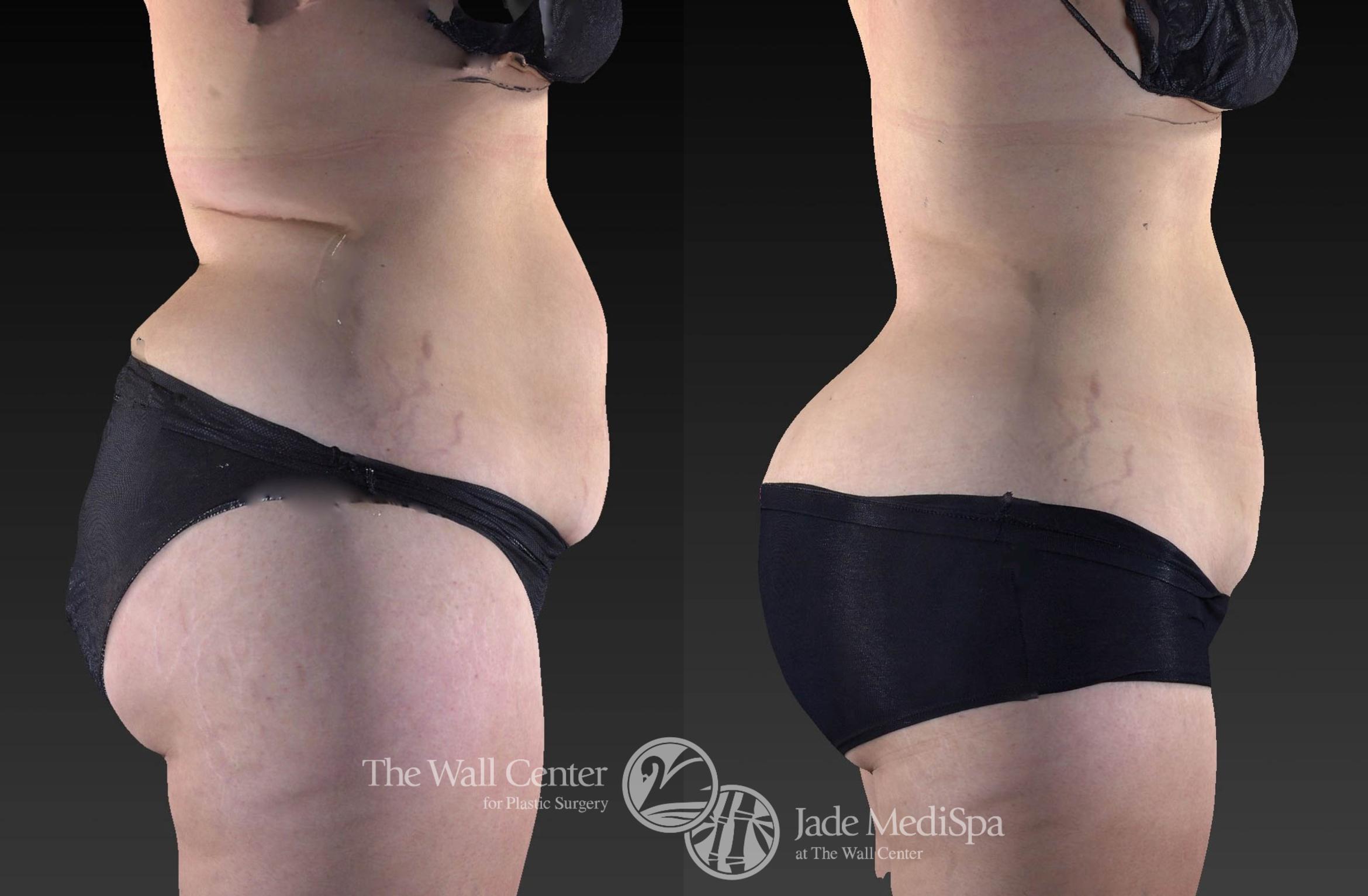 CoolSculpting Right Side Photo, Shreveport, Louisiana, Jade Medispa, The Wall Center, Case 922