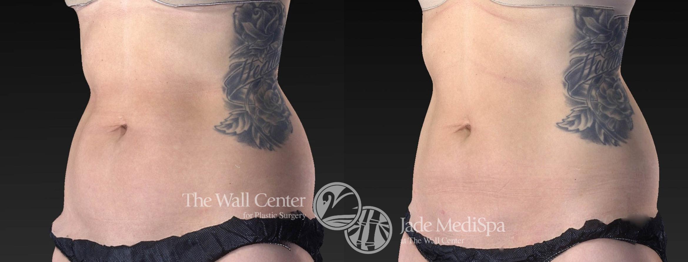 CoolSculpting Right Side Photo, Shreveport, Louisiana, Jade Medispa, The Wall Center, Case 972