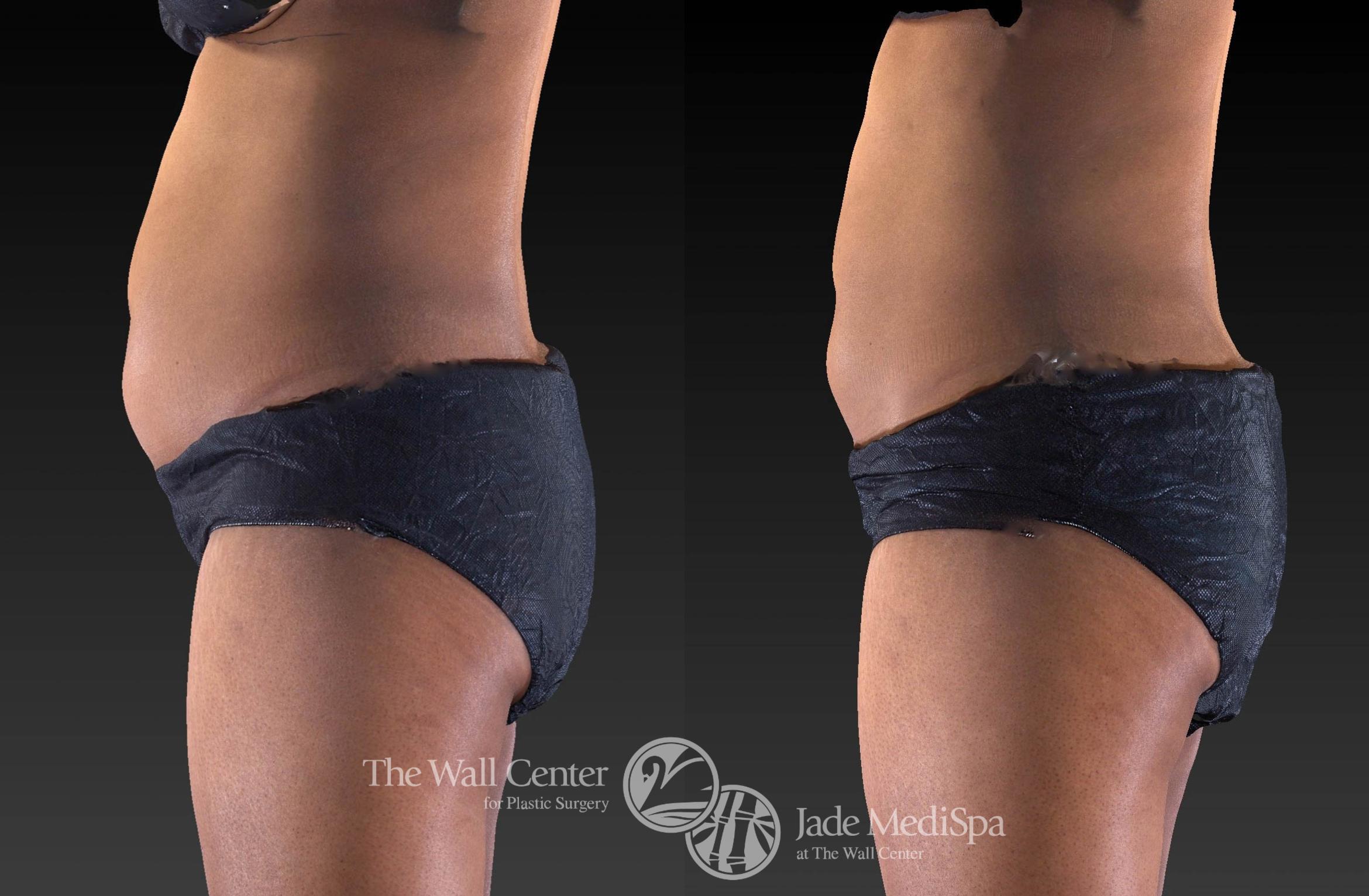 CoolSculpting Left Side Photo, Shreveport, Louisiana, Jade Medispa, The Wall Center, Case 978