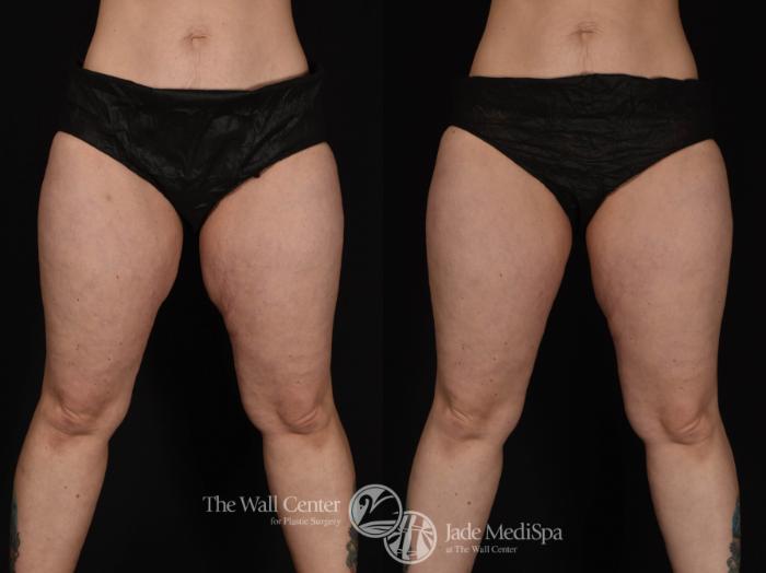 CoolSculpting Front Photo, Shreveport, Louisiana, Jade Medispa, The Wall Center, Case 979