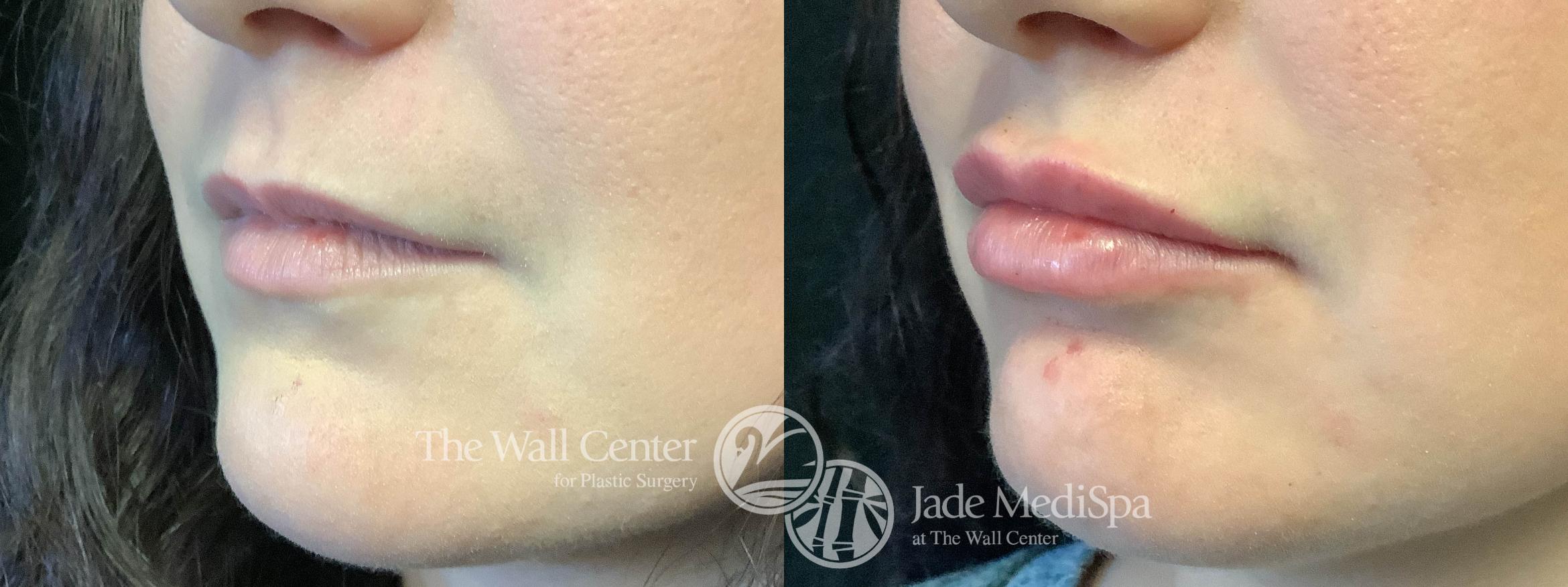 Before & After Dermal Fillers Case 1007 Left Side View in Shreveport, LA