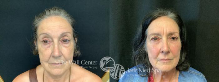 Before & After Dermal Fillers Case 1015 Front View in Shreveport, LA