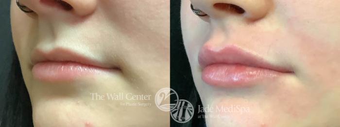 Before & After Dermal Fillers Case 1030 Left Oblique View in Shreveport, LA