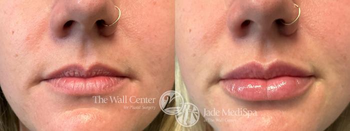 Before & After Dermal Fillers Case 1157 Front View in Shreveport, LA