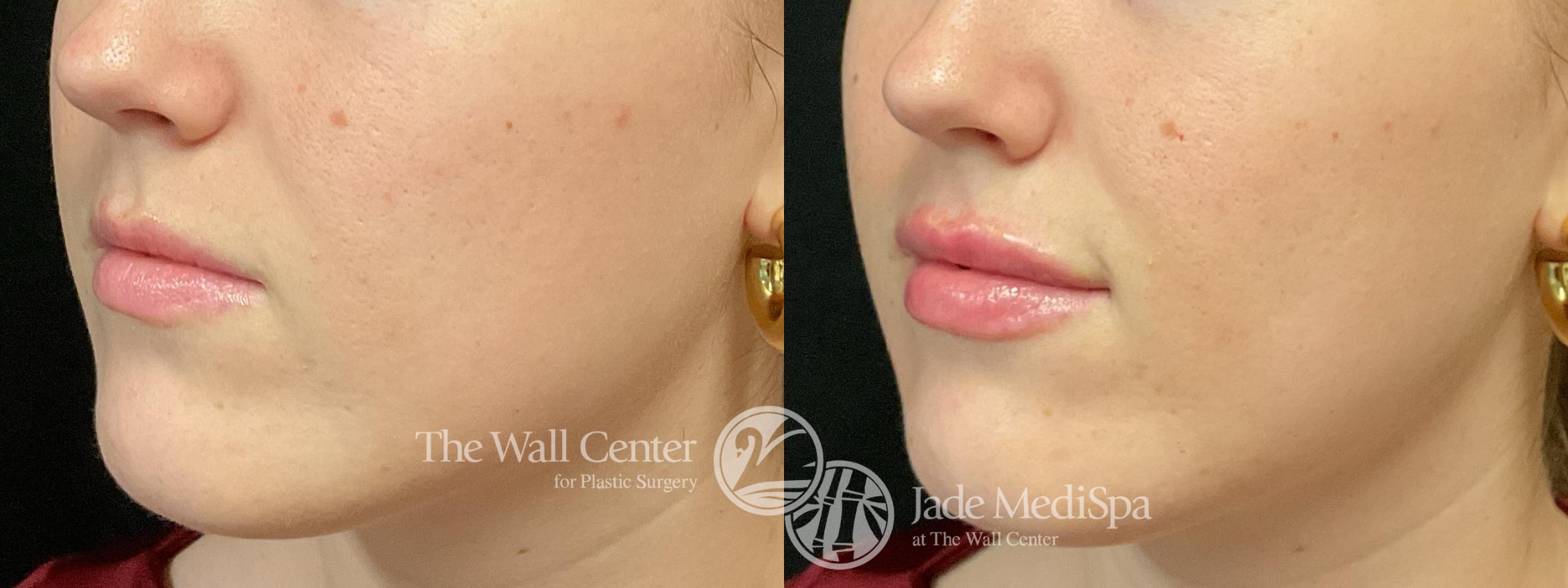 Before & After Dermal Fillers Case 1195 Left Oblique View in Shreveport, LA