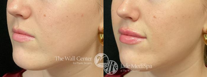 Before & After Dermal Fillers Case 1195 Left Oblique View in Shreveport, LA