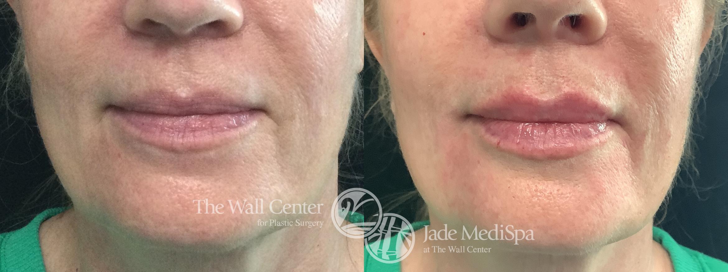 Before & After Dermal Fillers Case 1197 Front View in Shreveport, LA