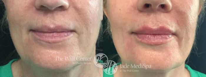 Before & After Dermal Fillers Case 1197 Front View in Shreveport, LA