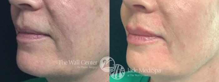 Before & After Dermal Fillers Case 1197 Left Oblique View in Shreveport, LA