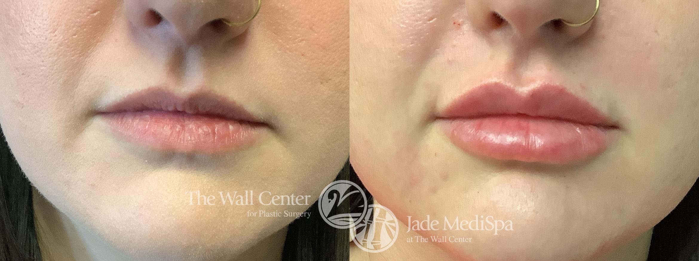 Before & After Dermal Fillers Case 1198 Front View in Shreveport, LA