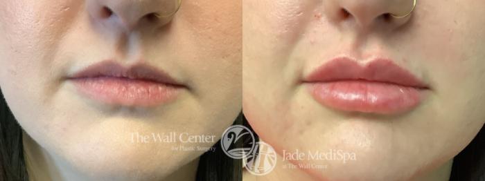 Before & After Dermal Fillers Case 1198 Front View in Shreveport, LA