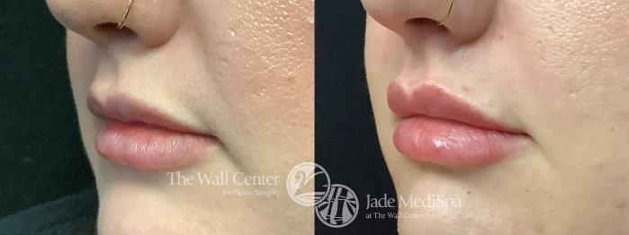 Before & After Dermal Fillers Case 1198 Left Oblique View in Shreveport, LA