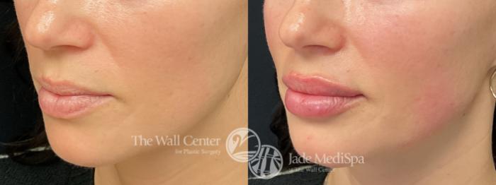Before & After Dermal Fillers Case 1199 Left Oblique View in Shreveport, LA