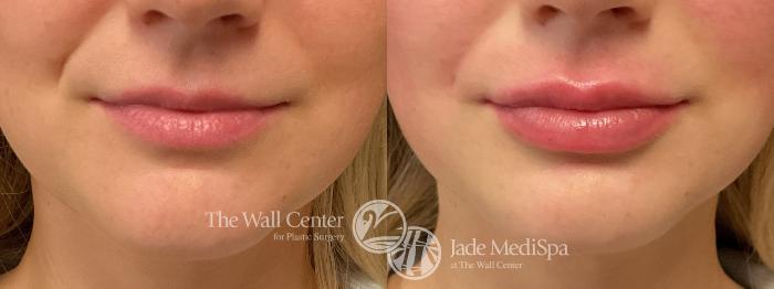 Before & After Dermal Fillers Case 1203 Front View in Shreveport, LA