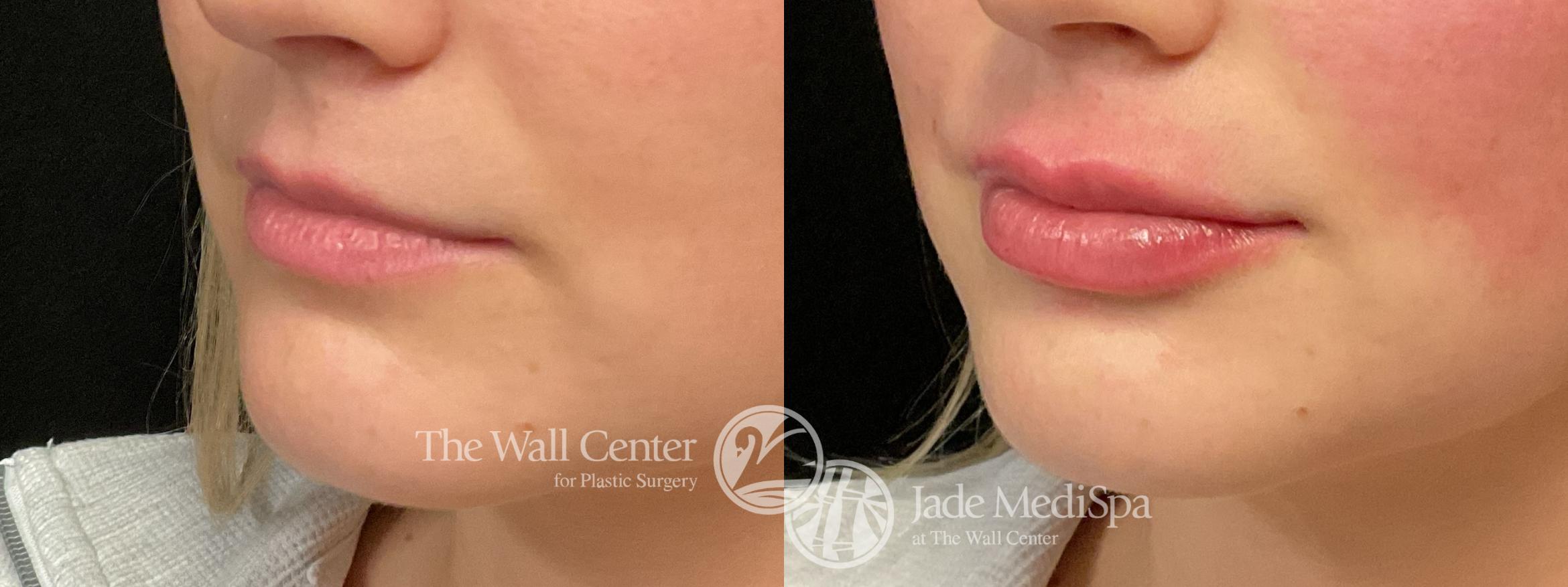 Before & After Dermal Fillers Case 1203 Left Oblique View in Shreveport, LA