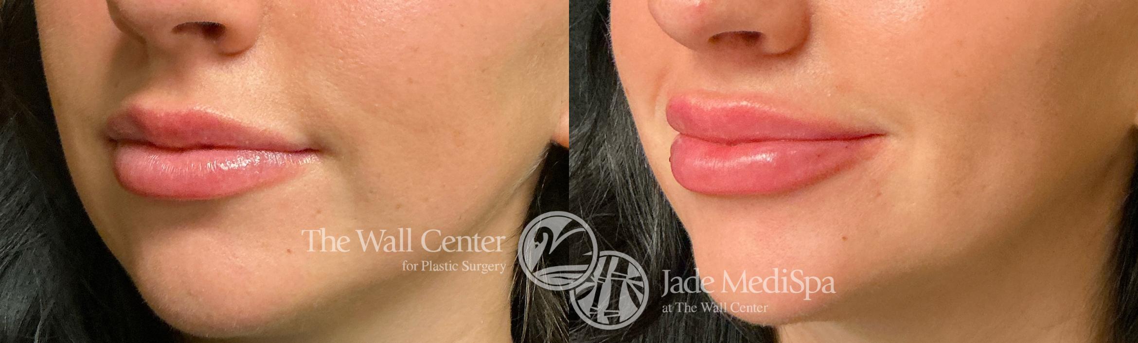 Before & After Dermal Fillers Case 1235 Left Oblique View in Shreveport, LA