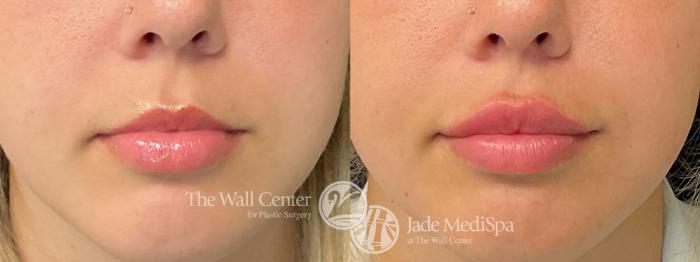 Before & After Dermal Fillers Case 1241 Front View in Shreveport, LA