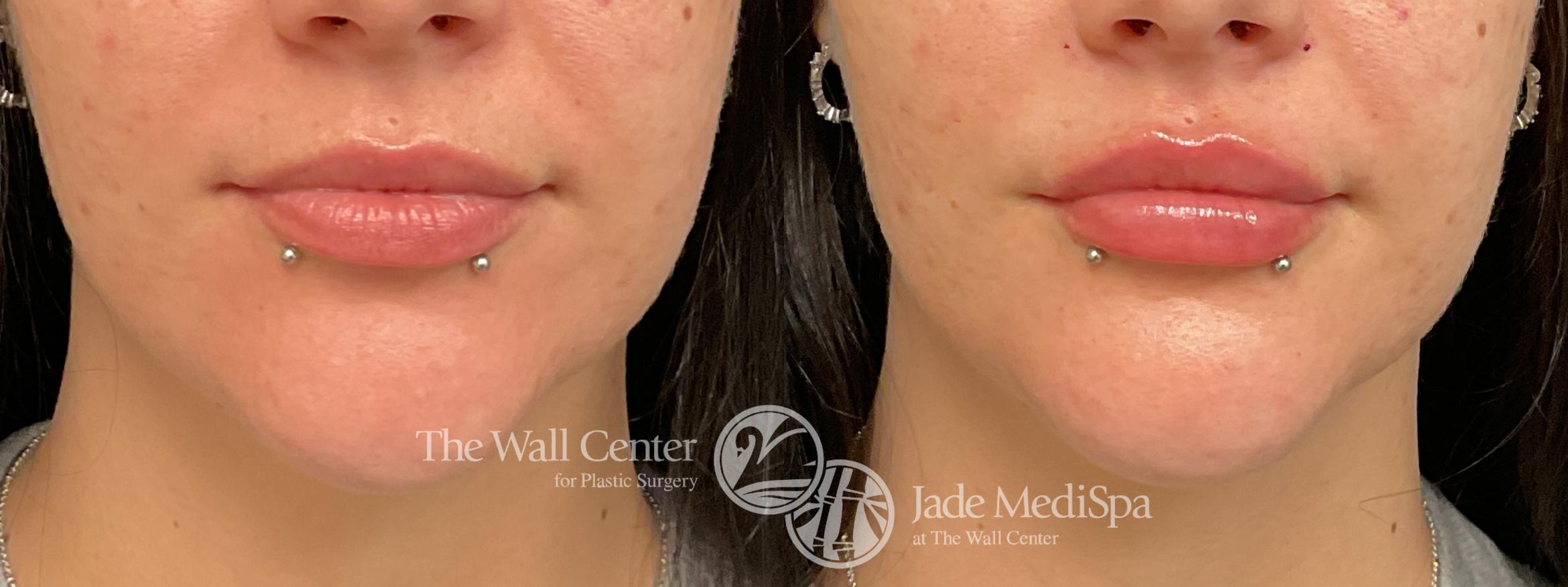 Before & After Dermal Fillers Case 1242 Front View in Shreveport, LA