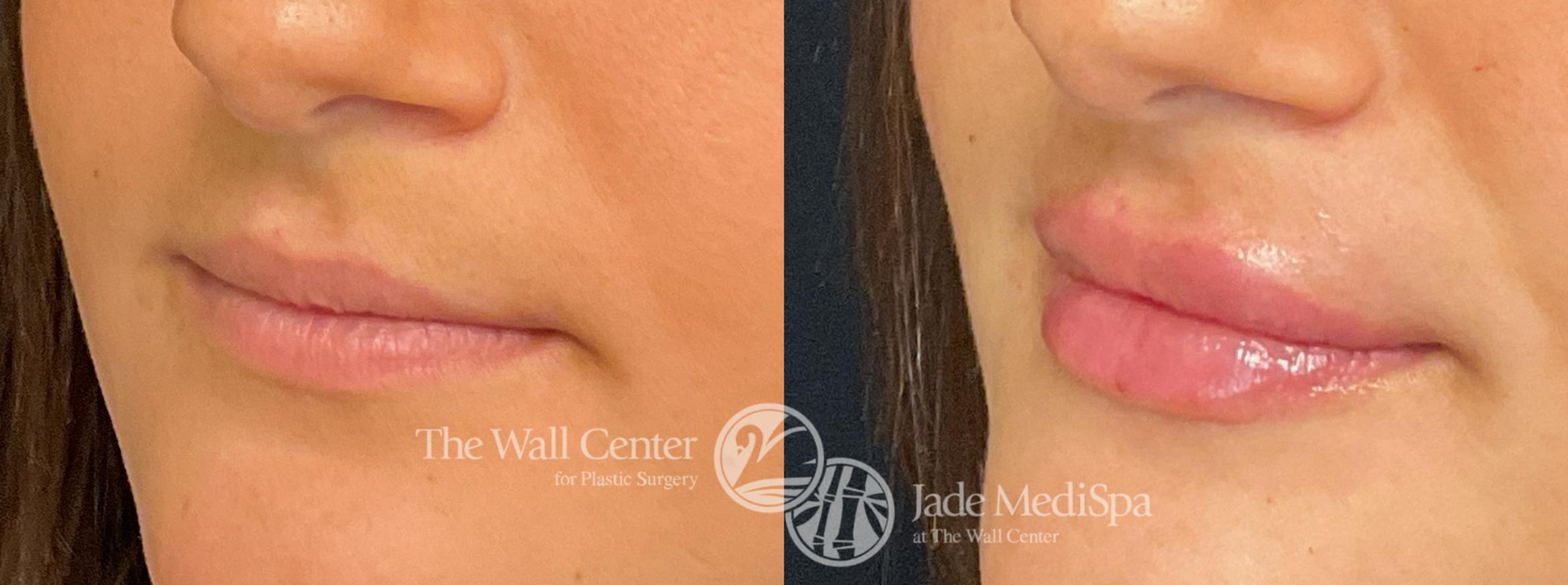 Before & After Dermal Fillers Case 1267 Left Oblique View in Shreveport, LA