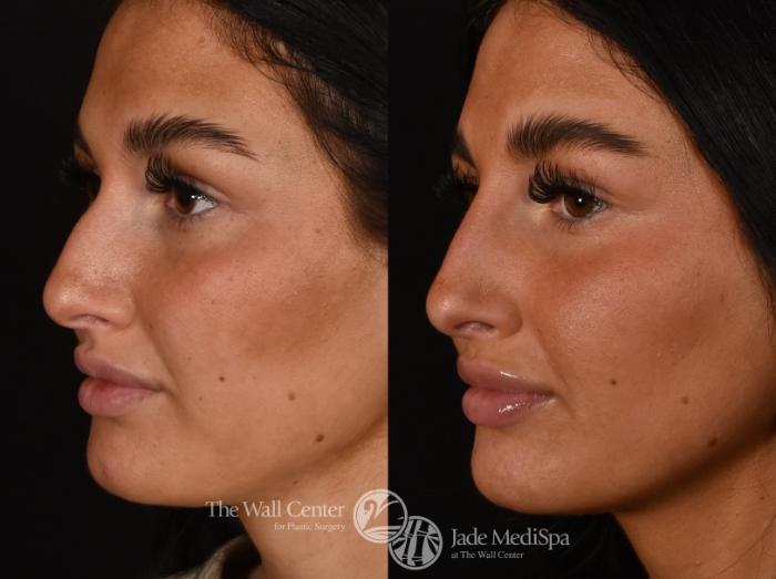 Before & After Dermal Fillers Case 1273 Left Side View in Shreveport, LA
