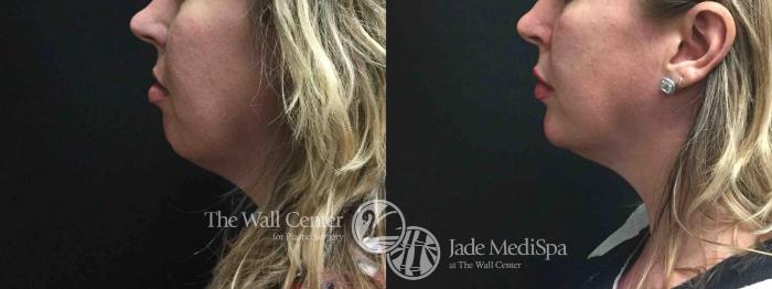 Before & After Cheek/Chin Augmentation Case 578 View #1 View in Shreveport, LA