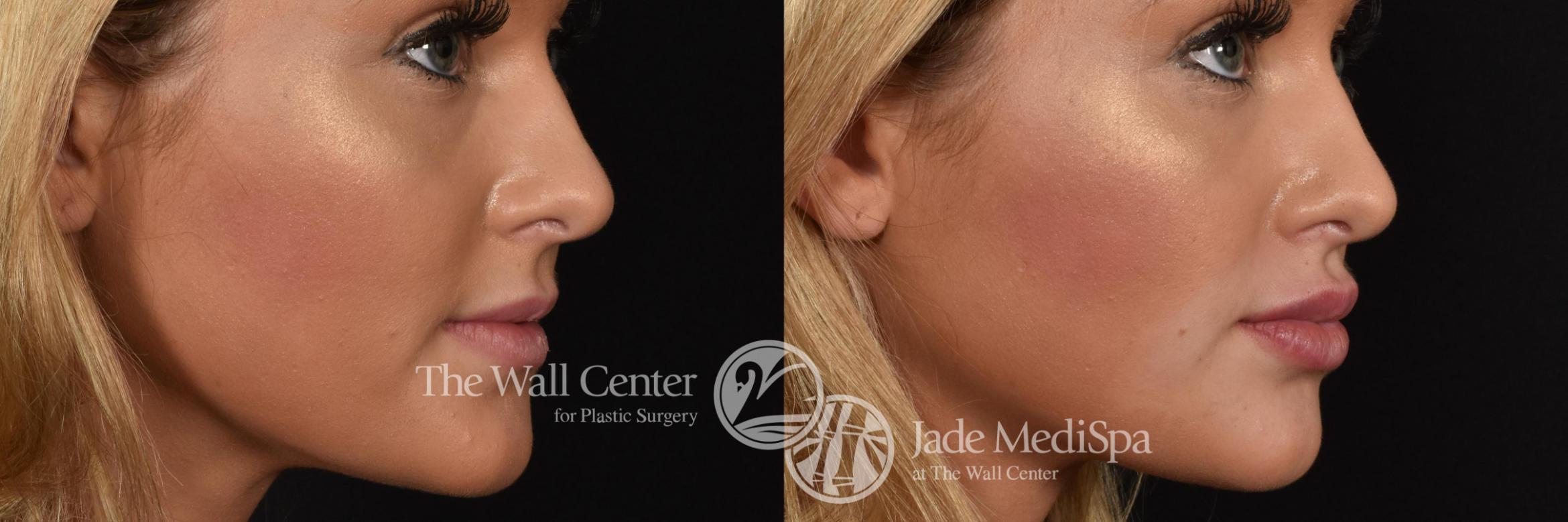 Dermal Fillers Case 608 Before & After View #2 | Shreveport, LA | The Wall Center