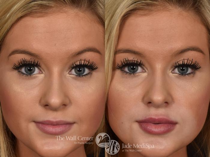 Before & After Lip Augmentation Case 608 View #3 View in Shreveport, LA
