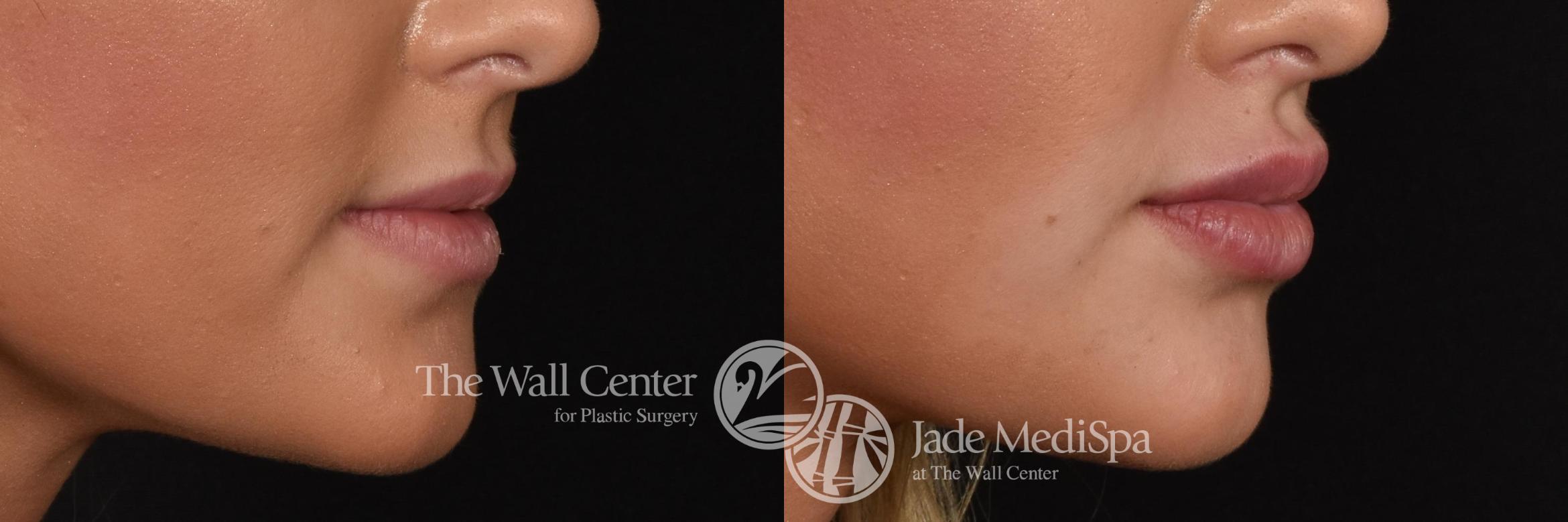 Dermal Fillers Case 608 Before & After View #4 | Shreveport, LA | The Wall Center