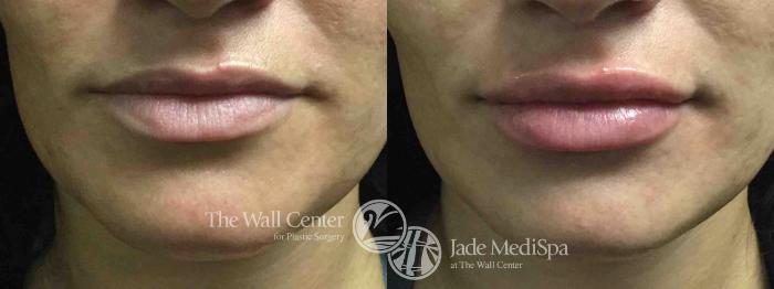 Before & After Lip Augmentation Case 633 VIEW #1 View in Shreveport, LA