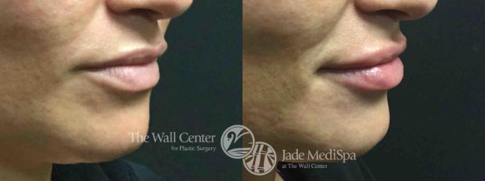 Before & After Lip Augmentation Case 633 VIEW #2 View in Shreveport, LA