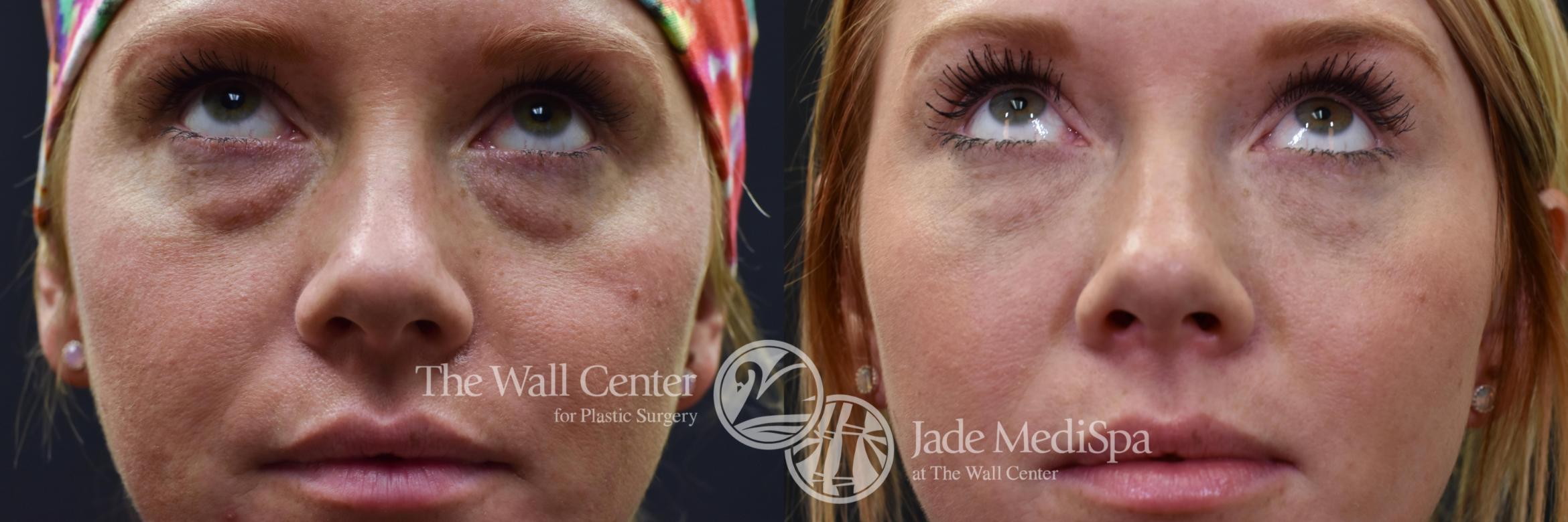 Dermal Fillers Case 639 Before & After VIEW #2 | Shreveport, LA | The Wall Center