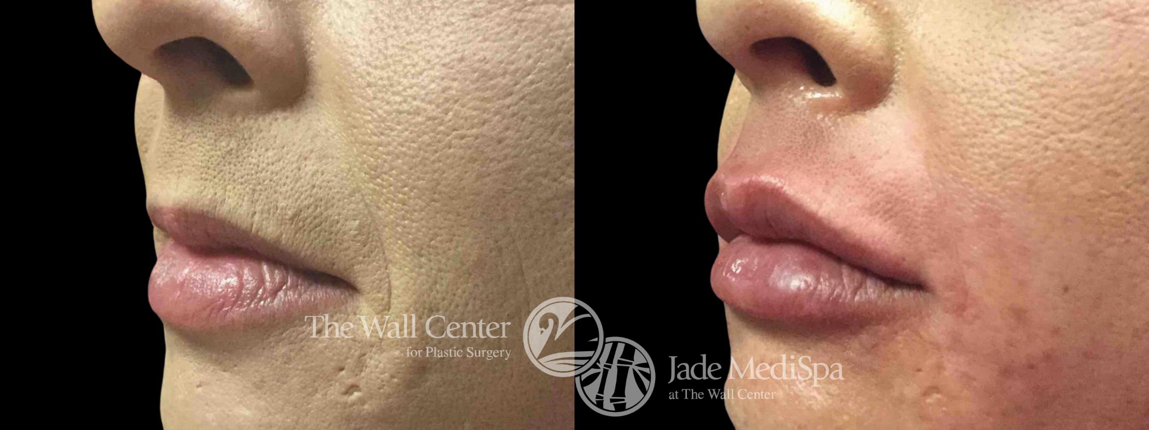Lip Filler Left Oblique Photo, Shreveport, LA, Jade MediSpa, The Wall Center, Case 650
