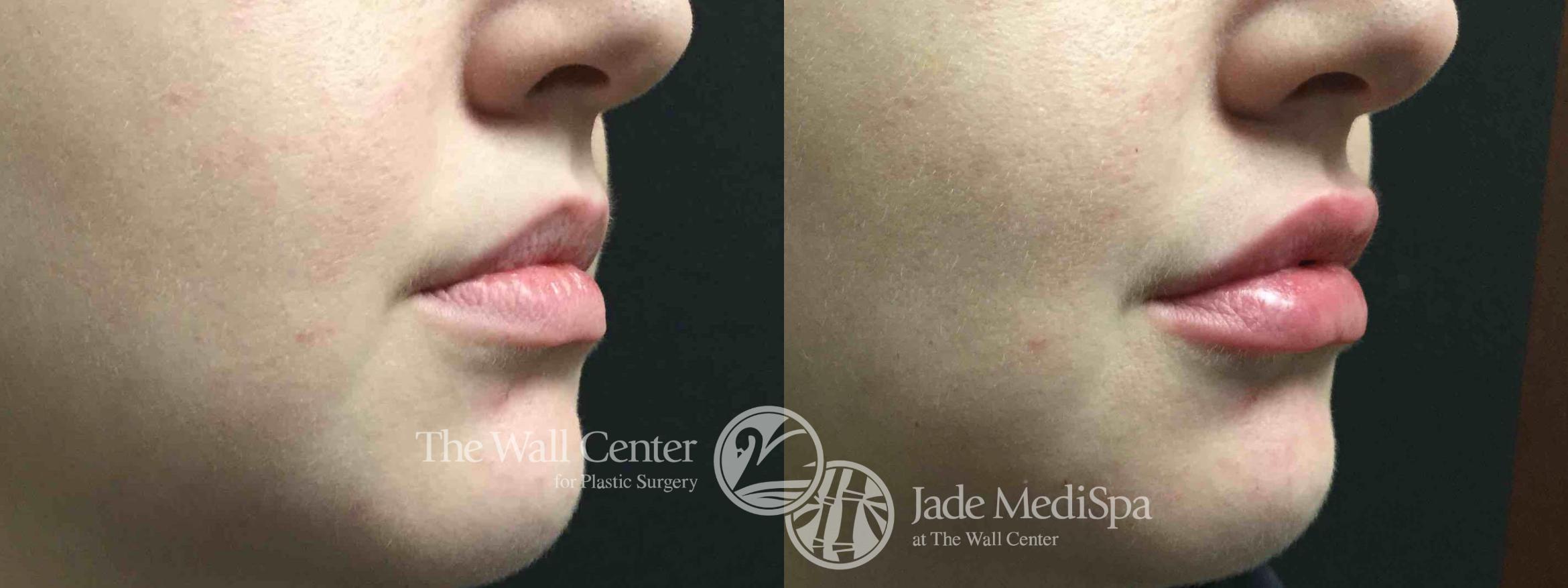 Before & After Lip Augmentation Case 711 VIEW #1 View in Shreveport, LA