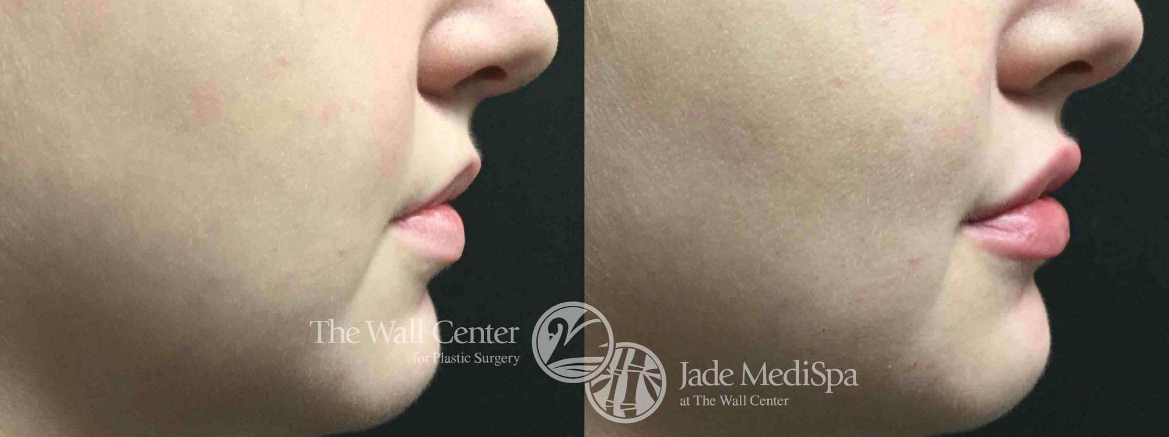 Before & After Dermal Fillers Case 711 VIEW #2 View in Shreveport, LA