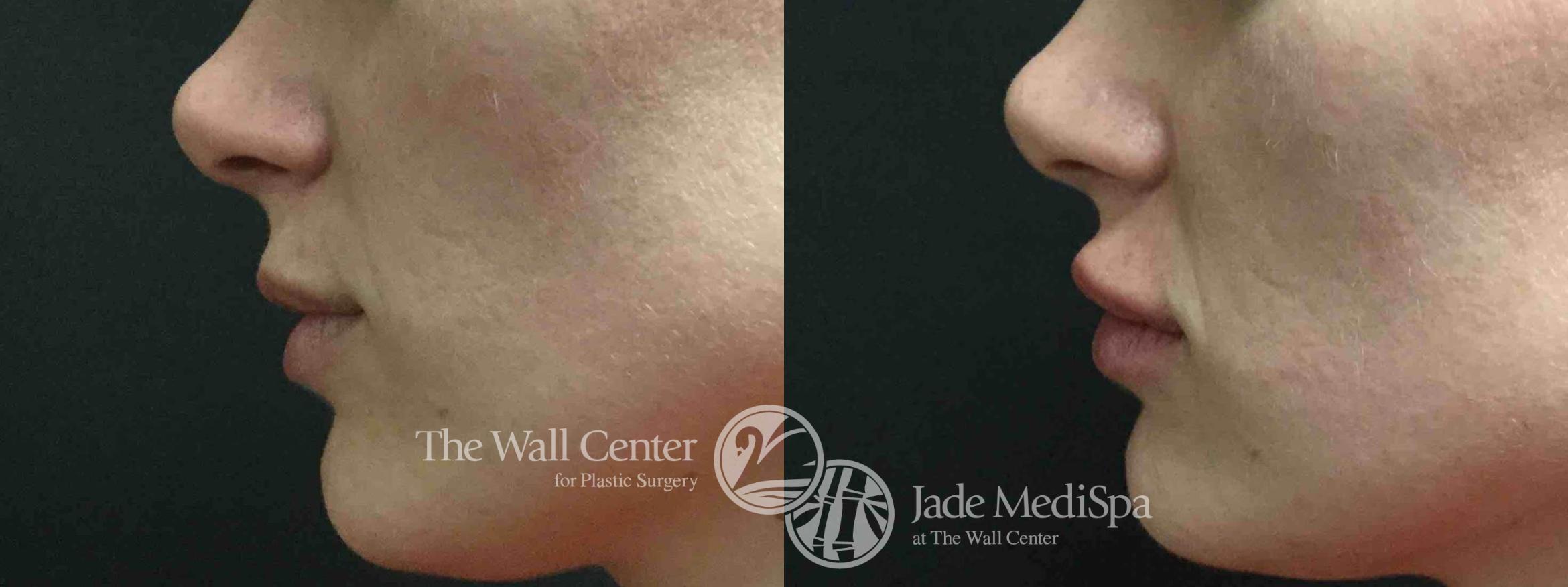 Dermal Fillers Case 712 Before & After VIEW #2 | Shreveport, LA | The Wall Center