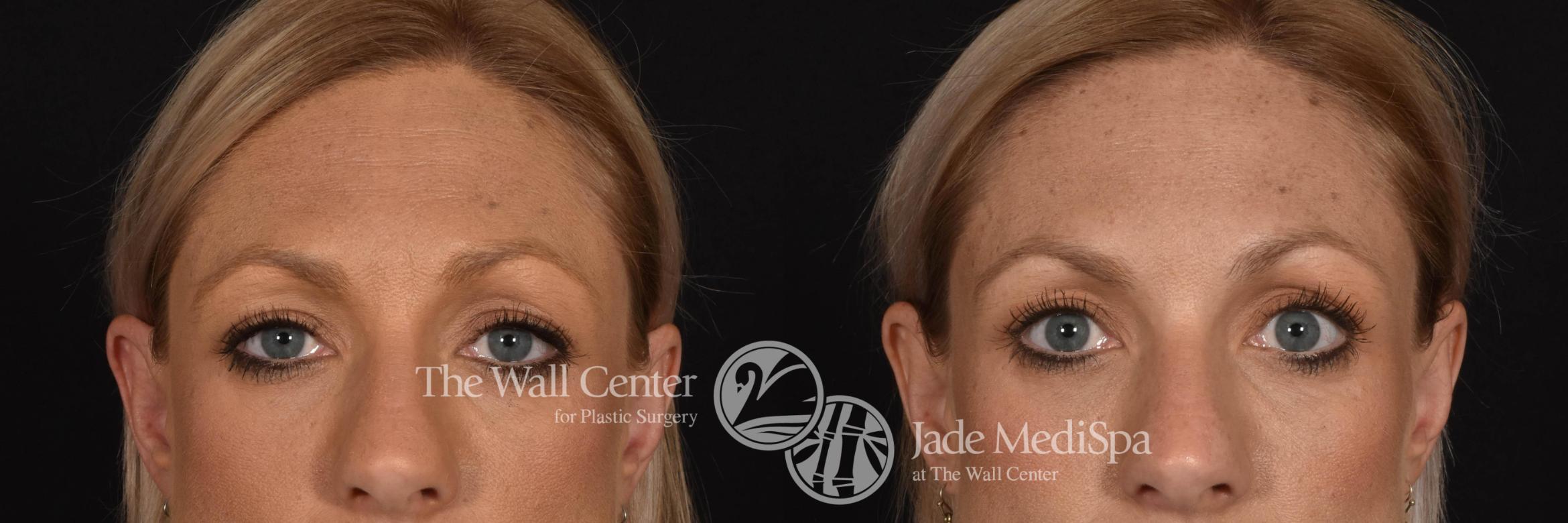 Before & After Dermal Fillers Case 745 VIEW #4 View in Shreveport, LA